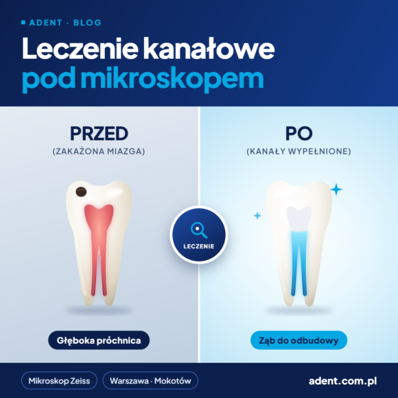 Korona po leczeniu kanałowym: kiedy jest niezbędna, a kiedy można bez niej