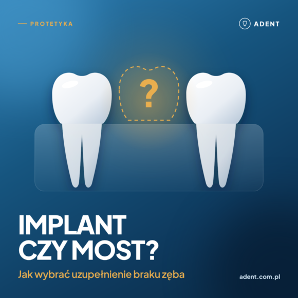 Implant czy most porcelanowy? Jak wybrać uzupełnienie braku zęba?